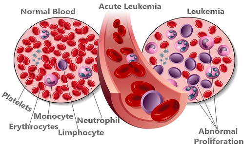 Best Acute Leukemia Treatment Cost in India Top Surgeon Doctor Hospital