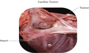 Cardiac Tumor