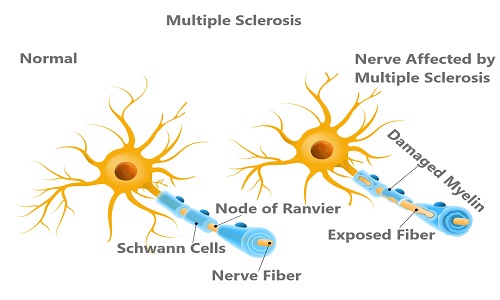 Multiple Sclerosis Treatment Cost in India Best Surgeon Hosptial Problem