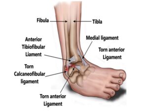 Ankle Ligament Tear