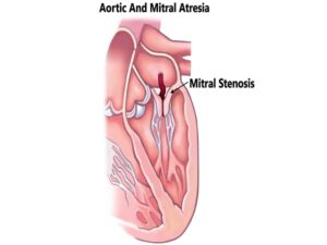 Aortic And Mitral Atresia.