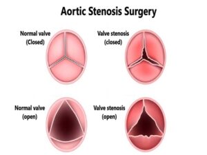 Aortic Stenosis Surgery (2)