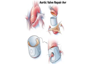 Aortic Valve Repair