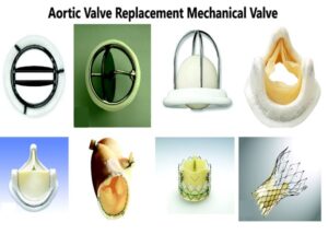 Aortic Valve Replacement Mechanical Valve