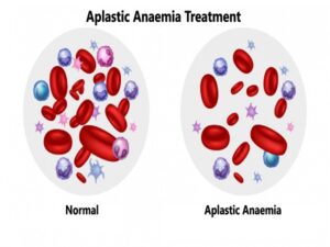 Aplastic Anaemia Treatment.