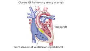 About Arterial switch operation/ Truncus arteriosus - Chief Tourism ...