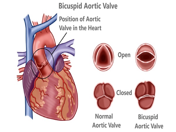 Bicuspid Aortic Valve - Chief Tourism Health Consult