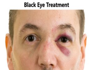 Black Eye Treatment