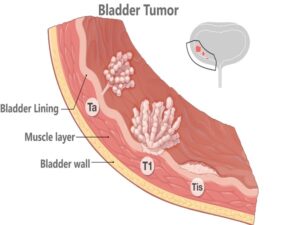 Bladder Tumor