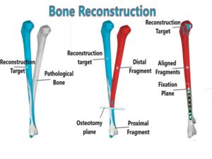 Bone Reconstruction