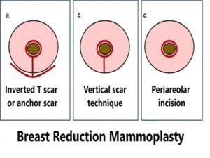 Breast Reduction Mammoplasty