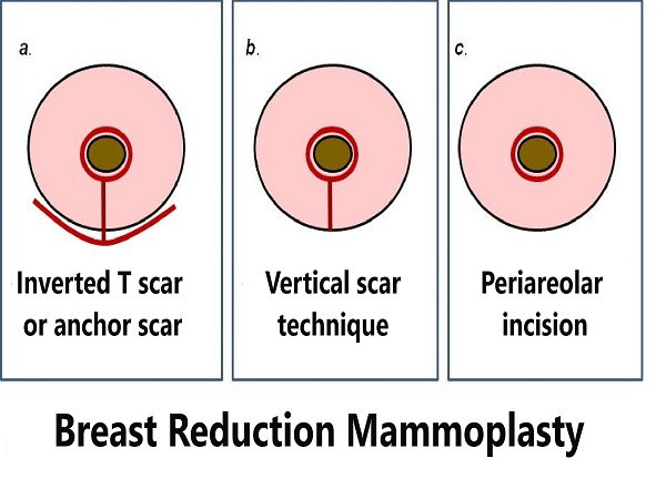 Breast Reduction Mammoplasty In India