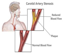 Carotid artery stenosis