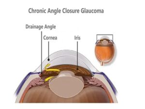 Chronic Angle Closure Glaucoma