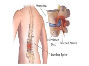 Chronic Spine And Back Pain
