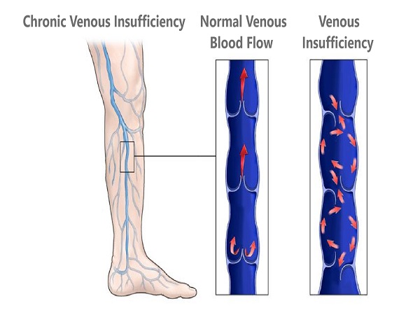 Chronic Venous Insufficiency In India