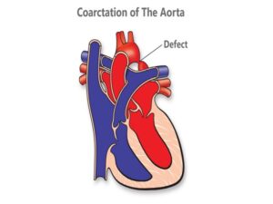 Coarctation of The Aorta