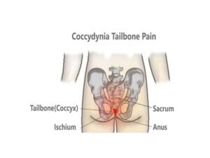 Coccydynia Tailbone Pain Treatment