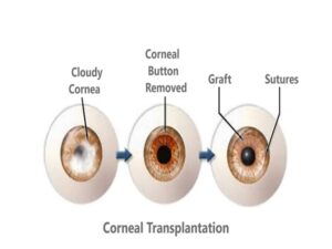 Corneal Transplantation Eye Transplant