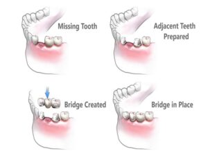 Dental Bridge In India