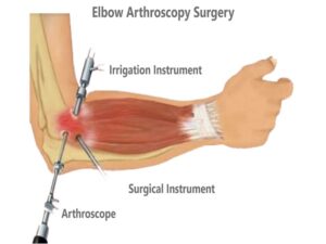 Elbow Arthroscopy Surgery