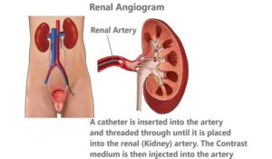 Renal Angiogram