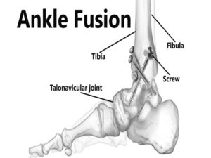 Ankle Fusion