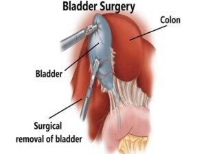 Bladder Surgery