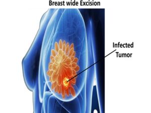 Breast wide Excision