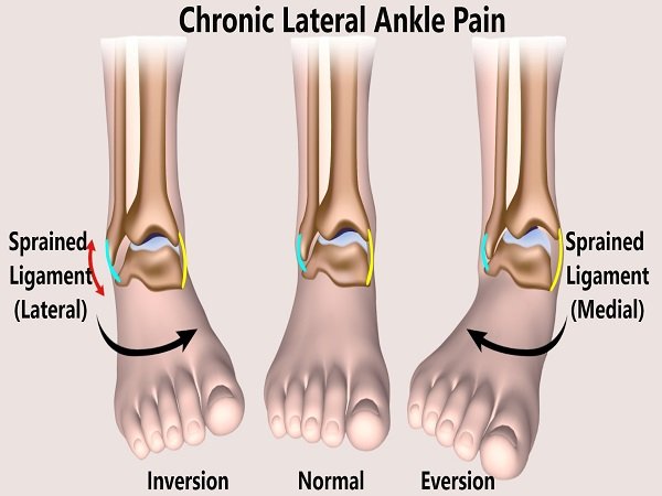 Calf Raises for Chronic Ankle | Foot Pain [NJ's Expert Chiropractor] -  YouTube