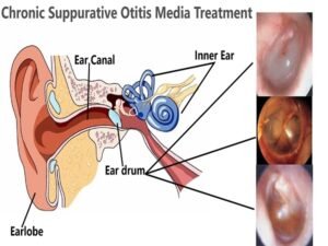Chronic Suppurative Otitis Media Treatment