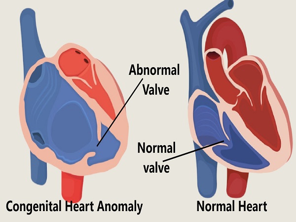 Congenital Heart Anomaly - Chief Tourism Health Consult