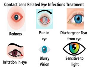 Contact Lens Related Eye Infections