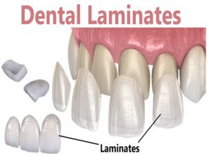 Dental Laminates