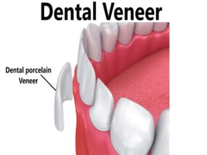Dental Veneer