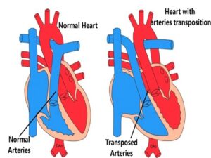 Dextro Transposition of The Great Arteries