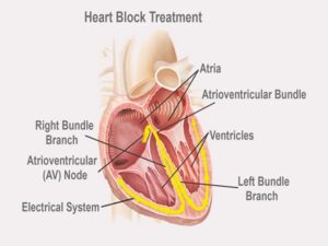Heart Block Treatment