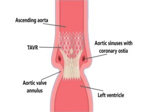 aortic valve regurgitation