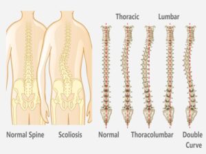 Adolescent Idiopathic Scoliosis Surgery in india