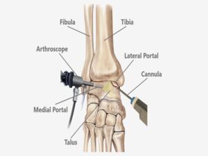 Ankle Arthroscopy in India