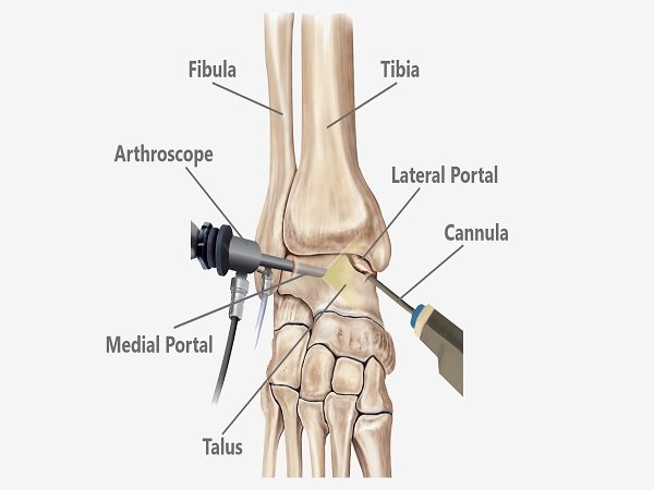 Ankle Arthroscopy or Arthroscopic Foot Surgery Hospital Cost