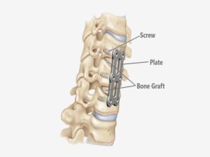 Anterior Cervical Corpectomy Spine Surgery in india