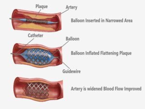 Balloon Angioplasty In India