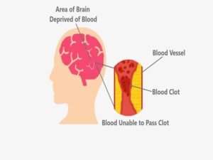 Blood Clot Brain Surgery in India