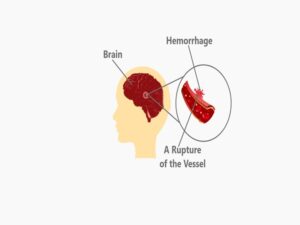 Brain Hemorrhage Treatment Cost In India