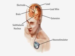 Deep Brain Stimulation Surgery (DBS) in India