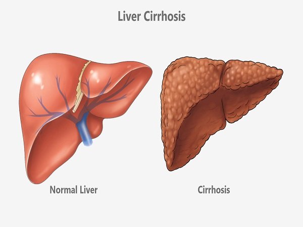Liver Cirrhosis Treatment Cost In India Surgeon Doctor Hospital