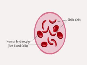 Sickle Cell Anemia Treatment in India