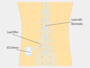 spinal cord stimulation for pain in india
