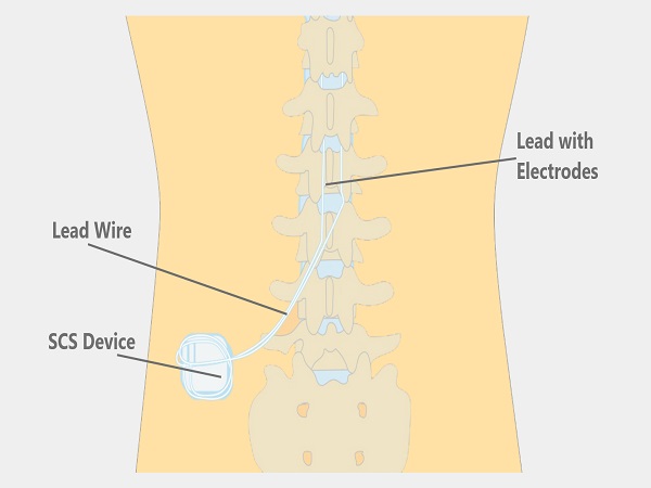 Spinal Cord Stimulators and Pain Pumps: Implantable Systems for Neuropathy